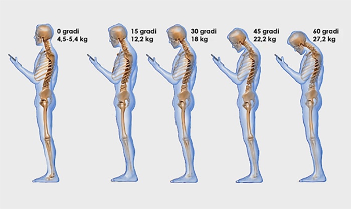 Cervicalgia - Text neck